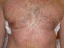 Gynaecomastia male after