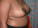 After Breast Reduction