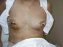 After Breast Lift