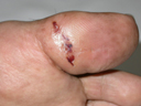 diabetic foot after surgery