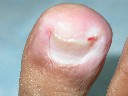 surgery for ingrowing toe nail before