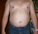 liposuction abdomen before surgery