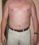 after liposuction abdomen surgery