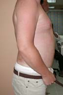 after liposuction abdomen surgery