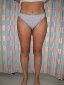 after liposuction thigh