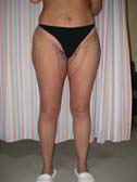 before liposuction thigh