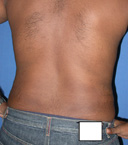 after liposuction waist