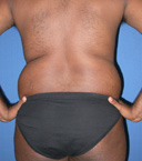 before liposuction waist