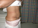 After Tummy Tuck surgery male