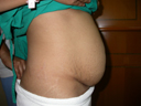Before Tummy Tuck Surgery - Male